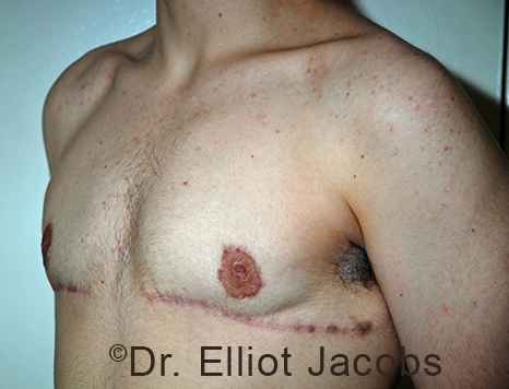 Gynecomastia. Male breast, after FTM Top Surgery treatment, l-side oblique view, patient 24