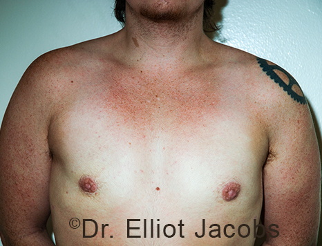 Gynecomastia. Male breast, after FTM Top Surgery treatment, front view, patient 21