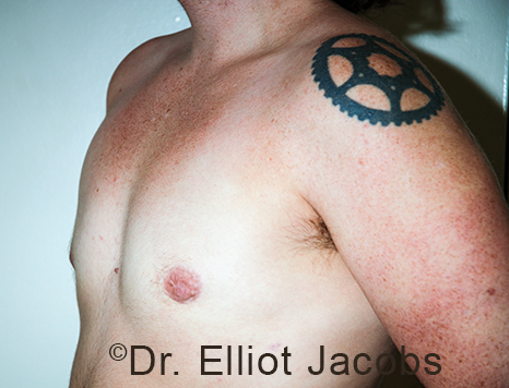 Gynecomastia. Male breast, after FTM Top Surgery treatment, l-side oblique view, patient 21