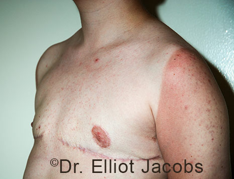 Gynecomastia. Male breast, after FTM Top Surgery treatment, l-side oblique view, patient 22