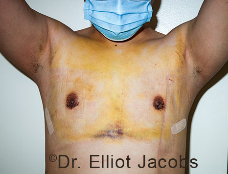 Men's breast, after Crater Deformity Repair treatment, front view - patient 6