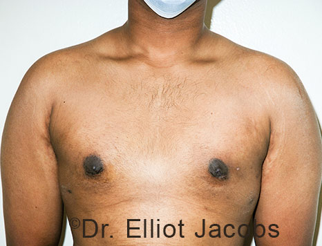 Male breast, after Gynecomastia treatment, front view, patient 110