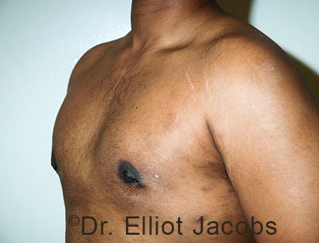 Male breast, after Gynecomastia treatment, l-side oblique view - patient 110