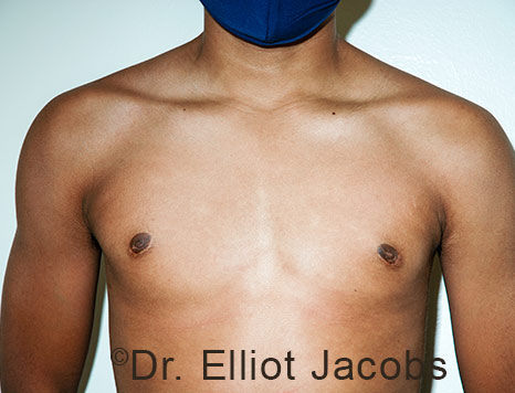 Men's breast, after Gynecomastia Adolescent treatment, front view - patient 40