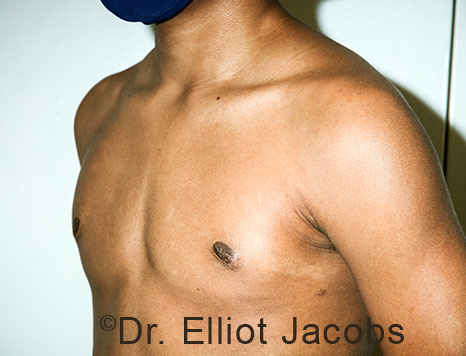 Men's breast, after Gynecomastia Adolescent treatment, oblique view - patient 40