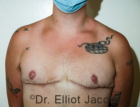 Gynecomastia. Male breast, after FTM Top Surgery treatment, front view, patient 23