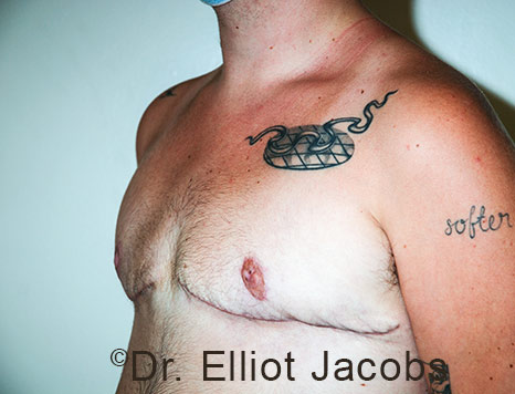 Gynecomastia. Male breast, after FTM Top Surgery treatment, l-side oblique view, patient 23