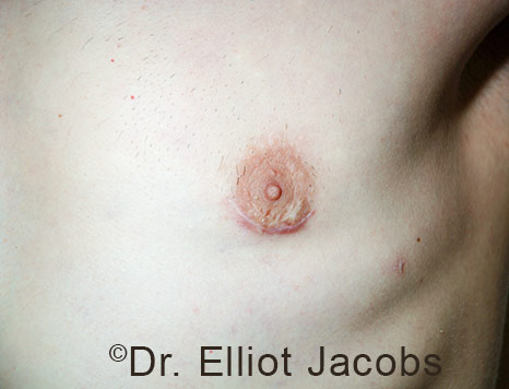 Men's breast, after Crater Deformity Repair treatment, front view - patient 7