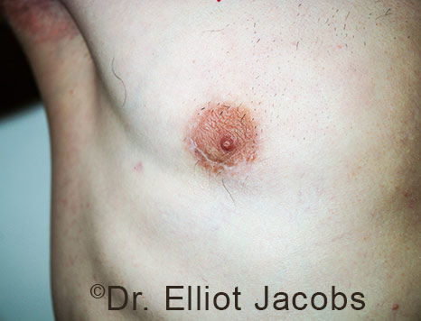 Men's breast, after Crater Deformity Repair treatment, front view, patient 7