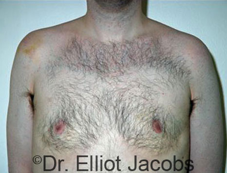 Male breast, after Gynecomastia treatment, front view, patient 32