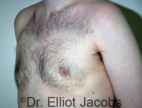 Male breast, after Gynecomastia treatment, l-side oblique view - patient 32