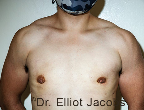 Gynecomastia. Male breast, after FTM Top Surgery treatment, front view, patient 25