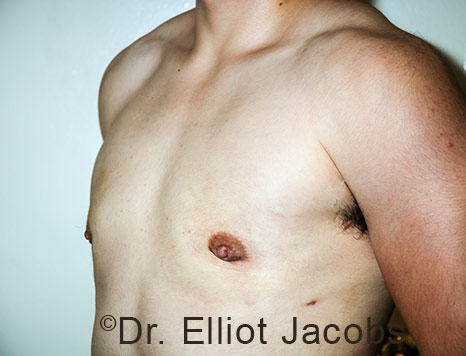 Gynecomastia. Male breast, after FTM Top Surgery treatment, l-side oblique view, patient 25