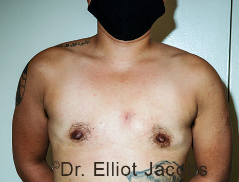 Gynecomastia. Male breast, after FTM Top Surgery treatment, front view, patient 26