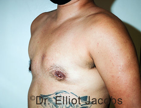 Gynecomastia. Male breast, after FTM Top Surgery treatment, l-side oblique view, patient 26