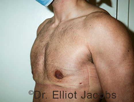 Gynecomastia. Male breast, after FTM Top Surgery treatment, l-side oblique view, patient 27