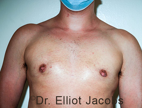Gynecomastia. Male breast, after FTM Top Surgery treatment, front view, patient 28