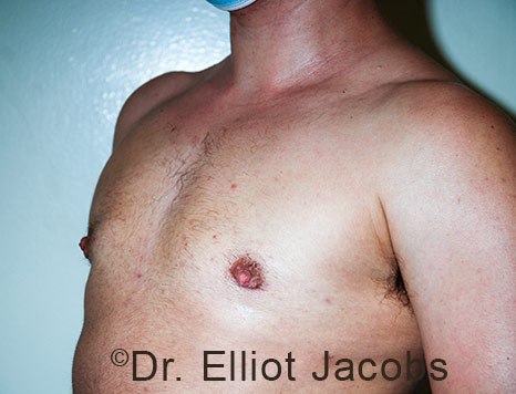 Gynecomastia. Male breast, after FTM Top Surgery treatment, l-side oblique view, patient 28