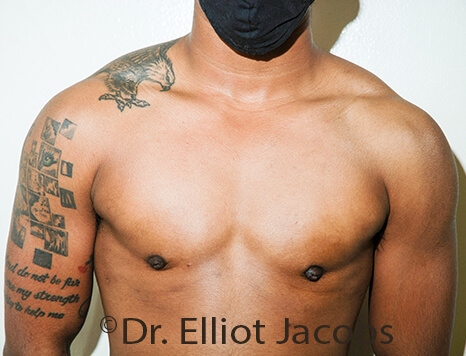 Gynecomastia. Male breast, after FTM Top Surgery treatment, front view, patient 29