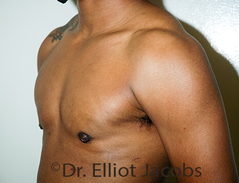 Gynecomastia. Male breast, after FTM Top Surgery treatment, l-side oblique view, patient 29