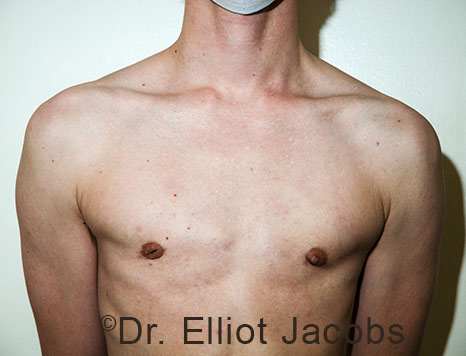 Gynecomastia. Male breast, after FTM Top Surgery treatment, front view, patient 30