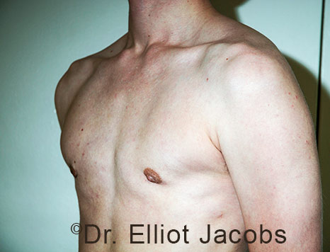 Gynecomastia. Male breast, after FTM Top Surgery treatment, l-side oblique view, patient 30