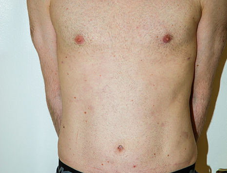 Male body, after Torsoplasty treatment, front view, patient 34