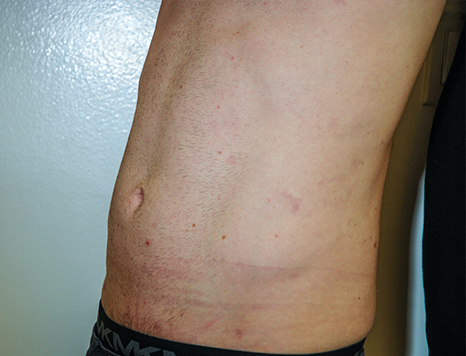 Male body, after Torsoplasty treatment, l-side oblique view, patient 34