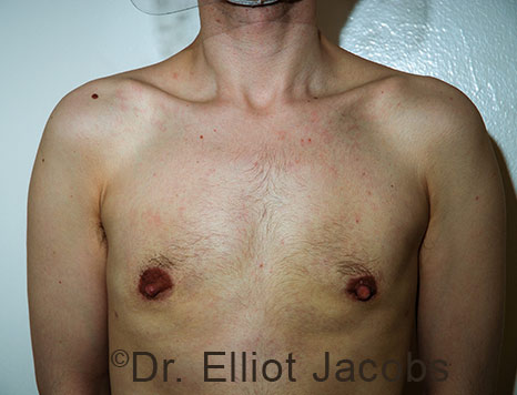 Male breast, after Gynecomastia treatment, front view, patient 111