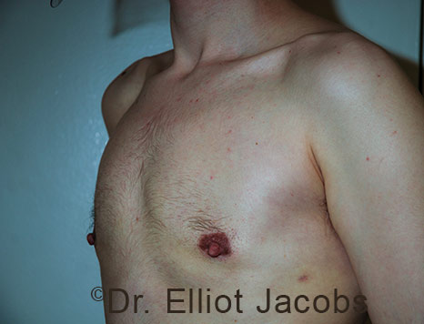 Male breast, after Gynecomastia treatment, l-side oblique view - patient 111