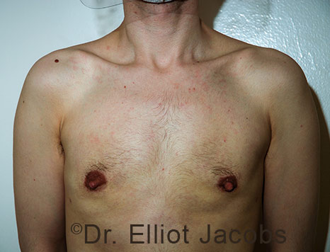 Gynecomastia. Male breast, after FTM Top Surgery treatment, front view, patient 31