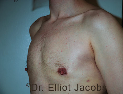 Gynecomastia. Male breast, after FTM Top Surgery treatment, l-side oblique view, patient 31
