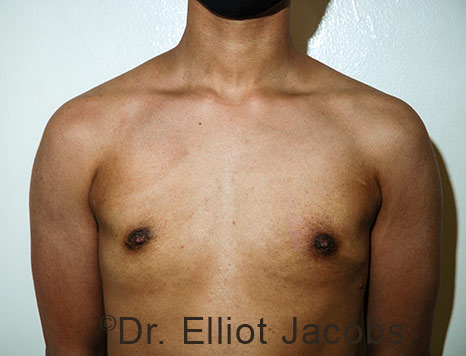 Gynecomastia. Male breast, after FTM Top Surgery treatment, front view, patient 32