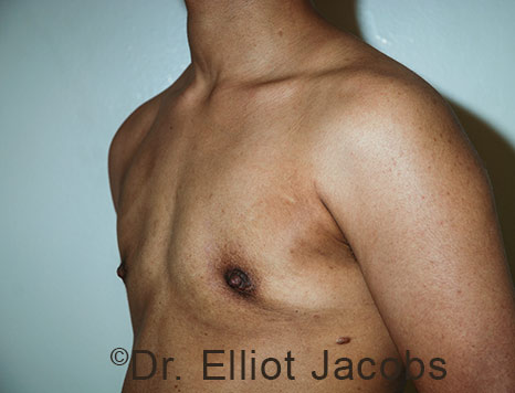 Gynecomastia. Male breast, after FTM Top Surgery treatment, l-side oblique view, patient 32