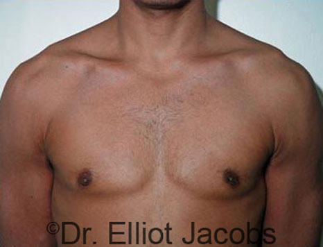 Male breast, after Gynecomastia treatment, front view, patient 33