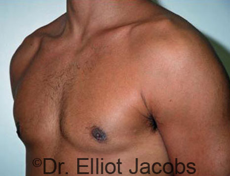 Male breast, after Gynecomastia treatment, l-side oblique view - patient 33