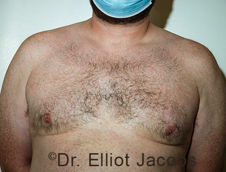 Male breast, after Gynecomastia treatment, front view, patient 112