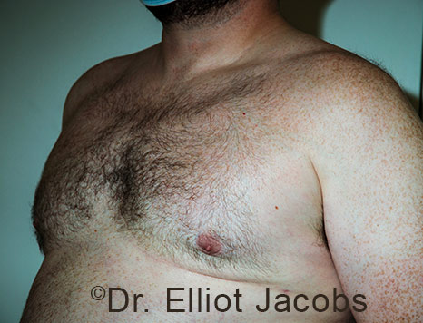 Male breast, after Gynecomastia treatment, l-side oblique view - patient 112