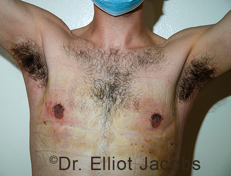 Men's breast, after Crater Deformity Repair treatment, front view - patient 8