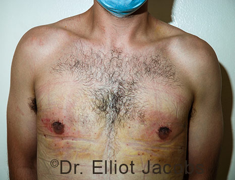 Men's breast, after Crater Deformity Repair treatment, front view, patient 8