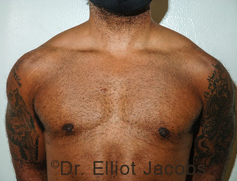 Male breast, after Gynecomastia treatment, front view, patient 113