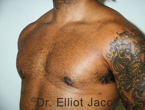 Male breast, after Gynecomastia treatment, l-side oblique view - patient 113