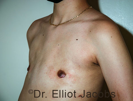 Gynecomastia. Male breast, after FTM Top Surgery treatment, l-side oblique view, patient 33