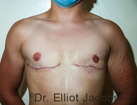 Gynecomastia. Male breast, after FTM Top Surgery treatment, front view, patient 34