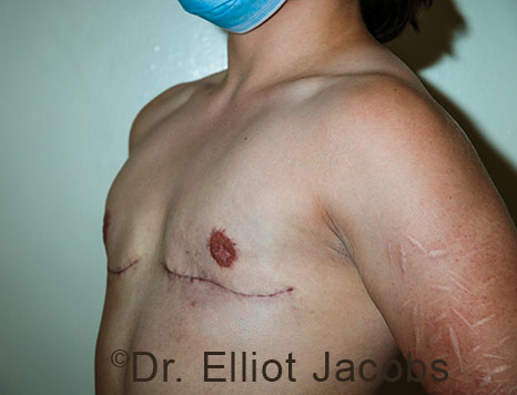 Gynecomastia. Male breast, after FTM Top Surgery treatment, l-side oblique view, patient 34