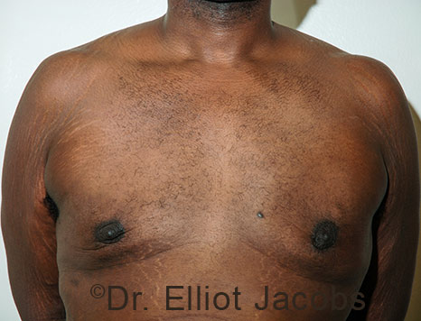 Male breast, after Gynecomastia treatment, front view, patient 114