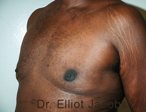 Male breast, after Gynecomastia treatment, l-side oblique view - patient 114