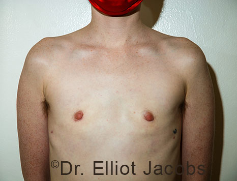 Gynecomastia. Male breast, after FTM Top Surgery treatment, front view, patient 35
