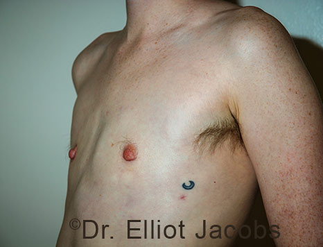 Gynecomastia. Male breast, after FTM Top Surgery treatment, l-side oblique view, patient 35