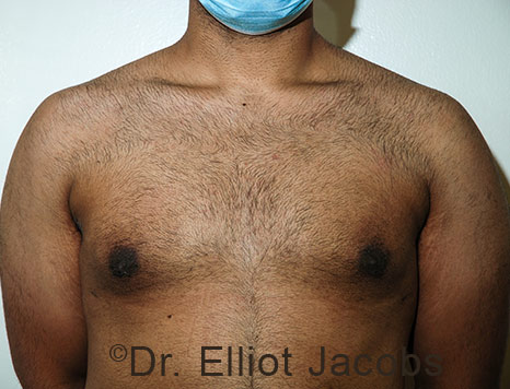 Male breast, after Gynecomastia treatment, front view, patient 115